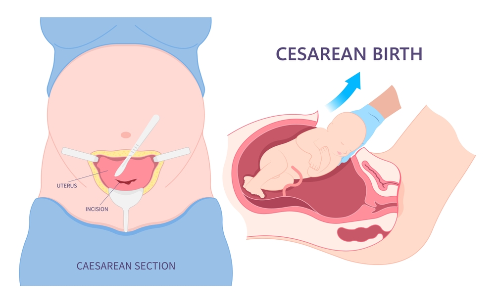 C-Section By Vardaan IVF Centre
